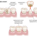 Crowns