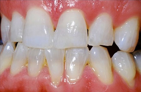 Whitening: After