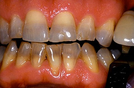 Whitening: Before