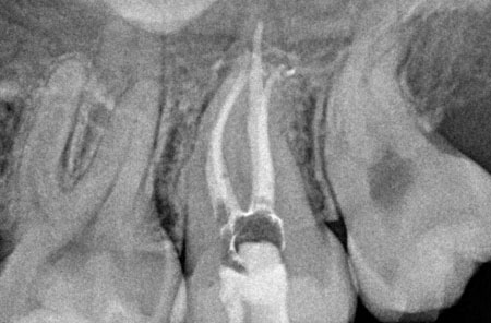 Root Canal: After