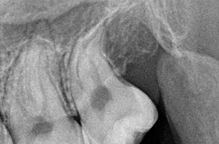 Root Canal: Before