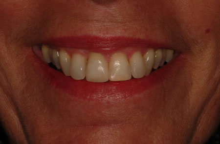 Veneers: After