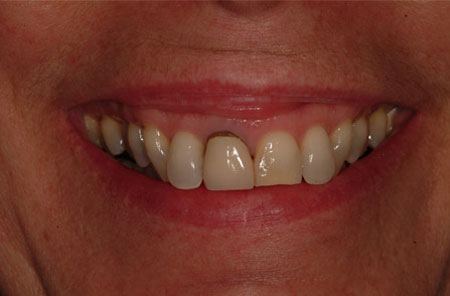 Veneers: Before