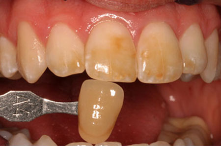 Teeth Whitening: Before